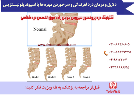 دلایل و درمان درد لغزندگی و سرخوردن مهره ها یا اسپوندیلولیستزیس 