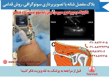 بلاک مفصل شانه با تصویربرداری سونوگرافی، روش قدامی