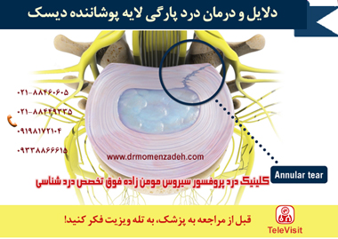 دلایل و درمان درد پارگی های حلقوی در ستون فقرات