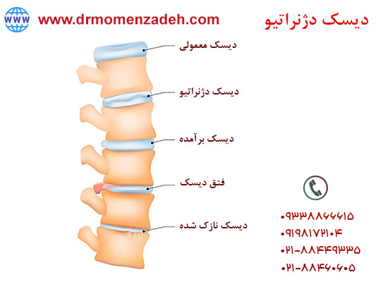 درد و علائم بیماری دیسک دژنراتیو کمر