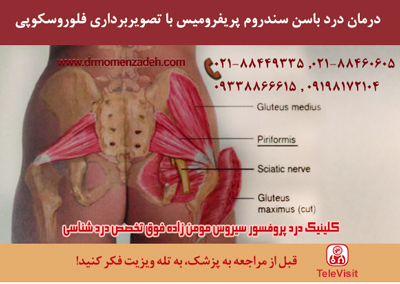 درمان درد باسن سندروم پریفرومیس با تصویربرداری فلوروسکوپی