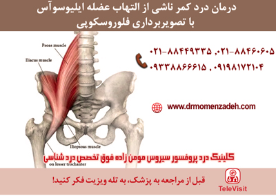 درمان درد کمر ناشی از التهاب عضله ایلیوسوآس با تصویربرداری فلوروسکوپی
