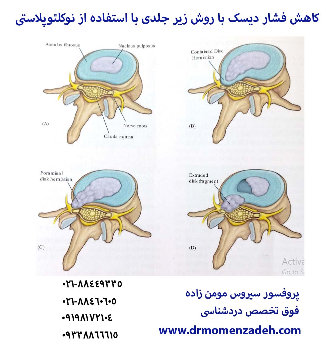 کاهش فشار دیسک با روش زیر جلدی با استفاده از نوکلئوپلاستی