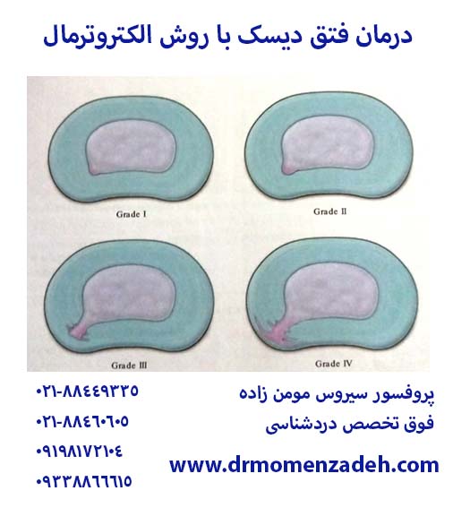 درمان فتق دسک با روش الکتروترمال