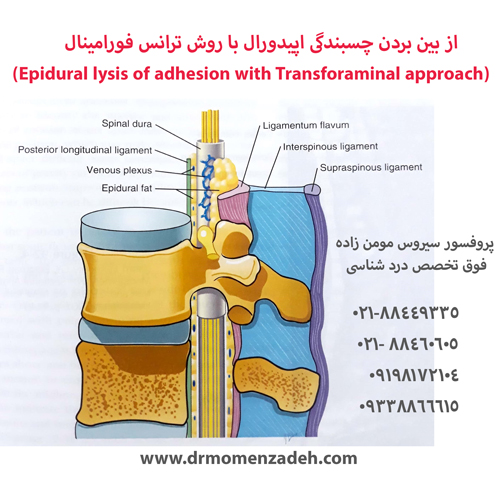 از بین بردن چسبندگی اپیدورال با روش ترانس فورامینال 