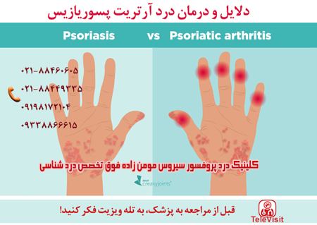 درد آرتریت پسوریازیس