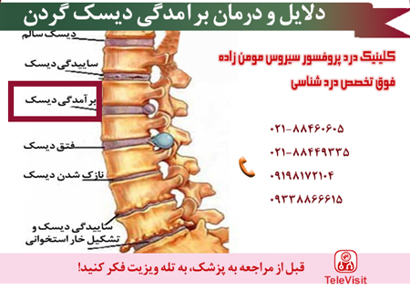 دلایل و درمان برآمدگی دیسک گردن