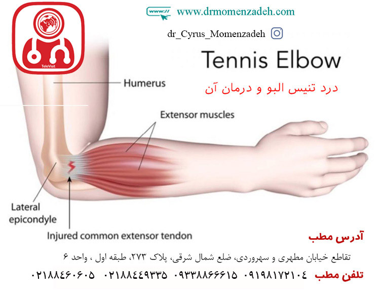 درد تنیس البو و درمان آن