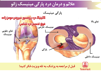 علائم و درمان درد پارگی مینیسک زانو