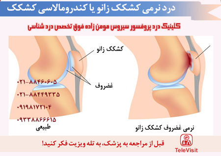 درد نرمی کشکک زانو یا کندرومالاسی کشکک