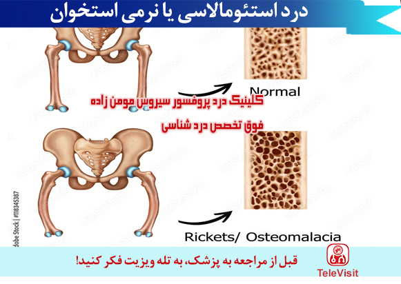 درد استئومالاسی یا نرمی استخوان 