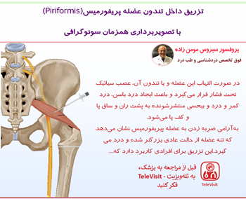 تزریق داخل تندون عضله پریفورمیس(Piriformis) با تصویربرداری همزمان سونوگرافی