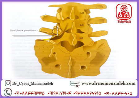 بلاک اپیدورال با روش ترانس فورامینال (Transforaminal)