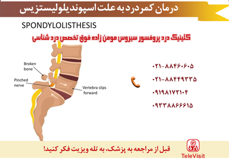 درمان کمردرد به علت اسپوندیلولیستزیس,اسپوندیلولیستزیس چیست و چه درمانی دارد؟