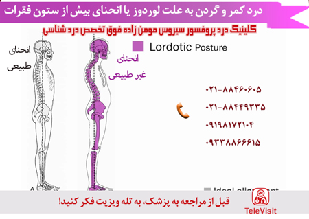 درد کمر و گردن به علت لوردوز یا انحنای بیش از ستون فقرات