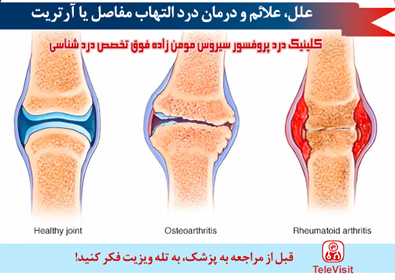 علل، علائم و درمان التهاب مفاصل یا آرتریت