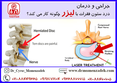 جراحی و درمان درد ستون فقرات با لیزر چگونه کار می کند؟