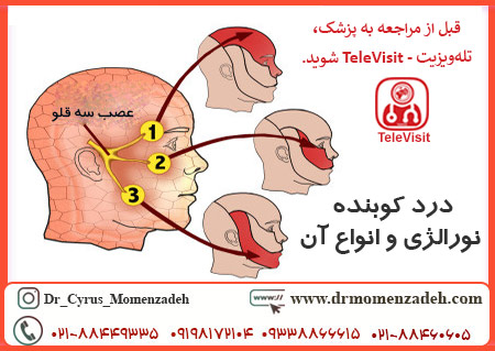 درد کوبنده نورالژی و انواع آن