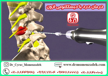درمان درد با دیسککتومی ازون