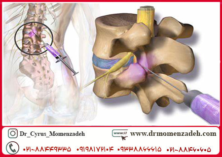 بلاک اعصاب نخاعی کمری (Lumbar) تحت گاید سونوگرافی