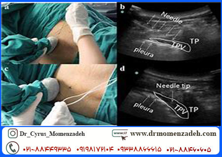 بلاک اعصاب پاراورتبرال سینه ای (Thoracic paravertebral) تحت گاید فلوروسکوپی