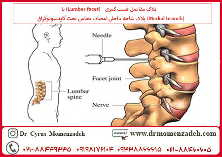 بلاک مفاصل فست کمری (Lumbar facet) با بلاک شاخه داخلی (Medial branch) اعصاب نخاعی تحت گایدسونوگرافی