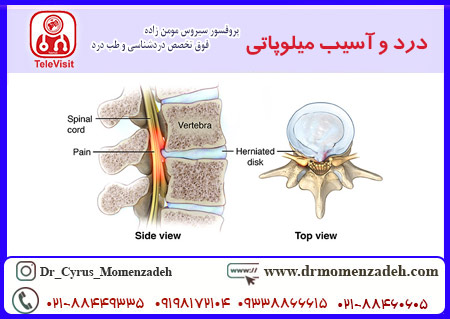 درد و آسیب میلوپاتی