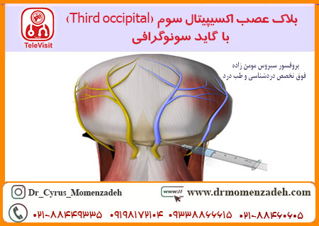 بلاک عصب اکسیپیتال سوم (Third occipital) با گاید سونوگرافی