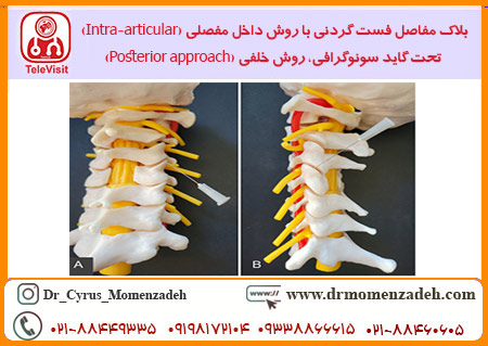 بلاک مفاصل فست گردنی با روش داخل مفصلی تحت گاید سونوگرافی، روش خلفی