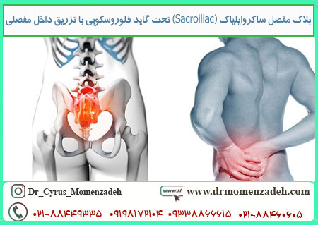 بلاک مفصل ساکروایلیاک (Sacroiliac) تحت گاید فلوروسکوپی با تزریق داخل مفصلی