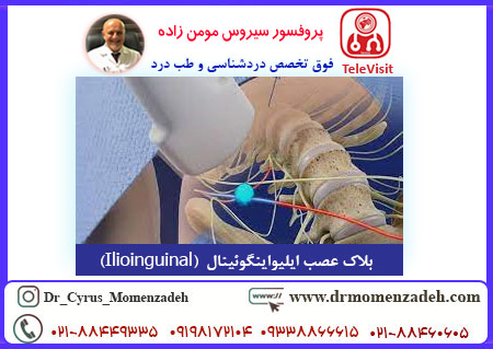 بلاک عصب ایلیواینگوئینال  (Ilioinguinal)