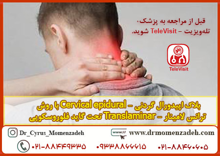 بلاک اپیدورال گردنی - Cervical epidural با روش ترانس لامینار - Translaminar تحت گاید فلوروسکوپی