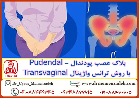 بلاک عصب پودندال - Pudendal با روش ترانس واژینال Transvaginal