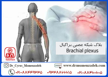بلاک شبکه عصبی براکیال-Brachial plexus تحت گاید سونوگرافی با روش سوپراکلاویکولار-Supraclavicular
