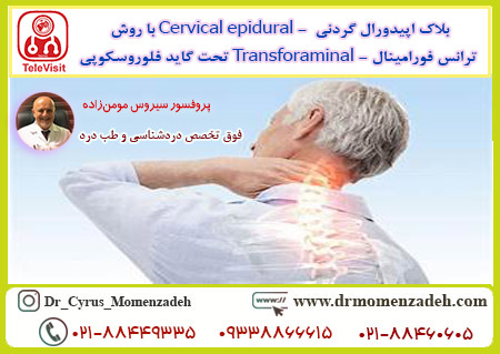 بلاک اپیدورال گردنی  - Cervical epidural با روش ترانس فورامینال - Transforaminal تحت گاید فلوروسکوپی
