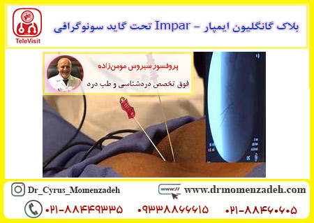 بلاک گانگلیون ایمپار - Impar تحت گاید سونوگرافی