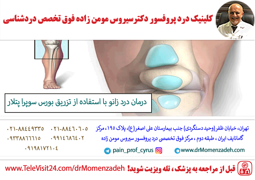 درمان درد زانو با استفاده از تزریق بورس سوپرا پتلار