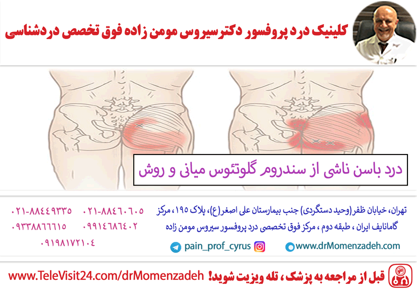 درد باسن ناشی از سندروم گلوتئوس میانی و روش های مختلف درمان