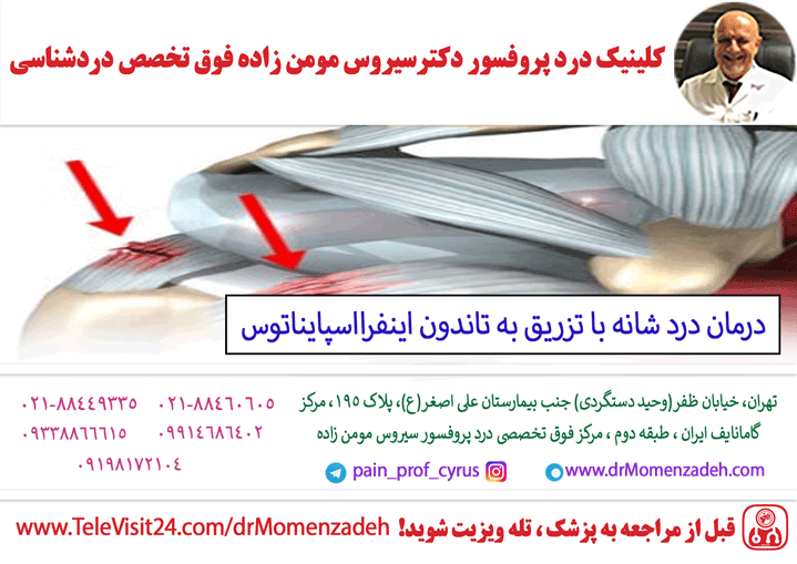 درمان درد شانه با تزریق به تندون اینفرااسپایناتوس (infrapinatus)