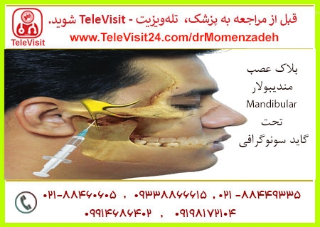 بلاک عصب مندیبولار _ Mandibular تحت گاید سونوگرافی