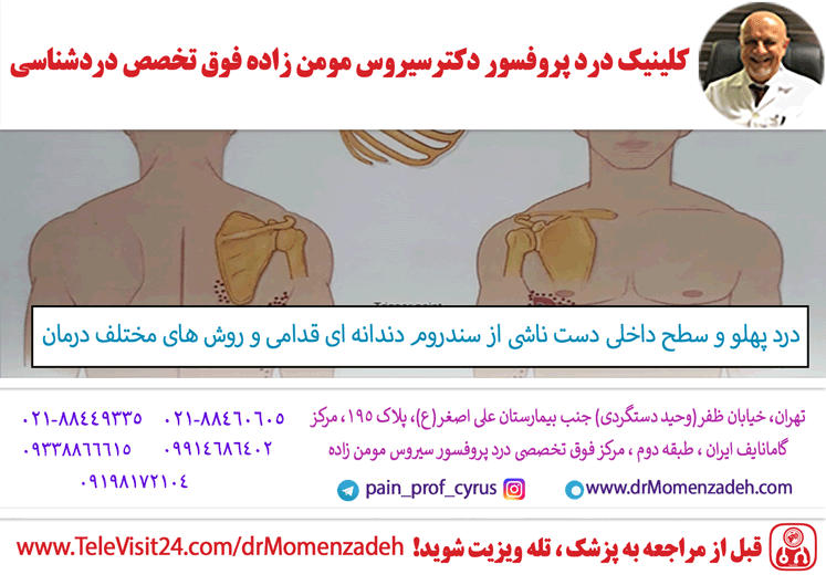 درد پهلو و سطح داخلی دست ناشی از سندروم دندانه ای قدامی و روش های مختلف درمان