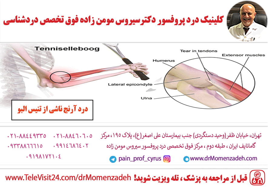 درد آرنج ناشی از تنیس البو