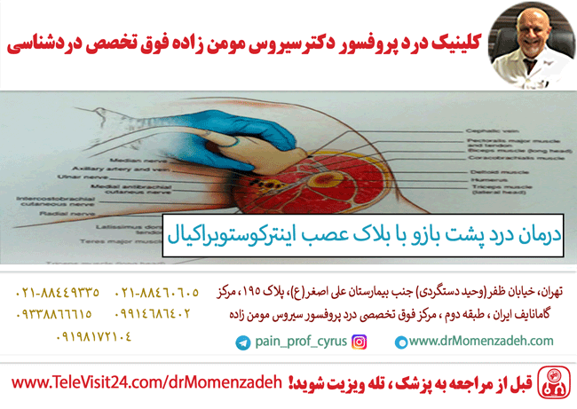 درمان درد پشت بازو با بلاک عصب اینترکوستوبراکیال (Intercostobrachial)