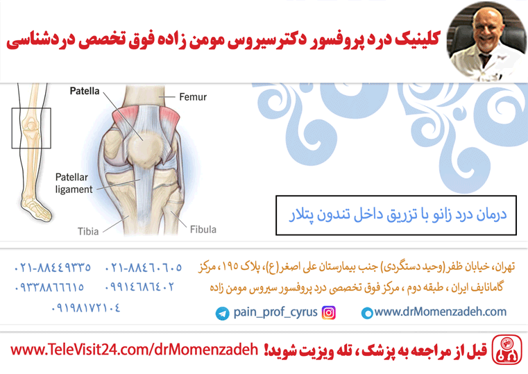 درمان درد زانو با تزریق داخل تندون پتلار (patellar، کشککی)