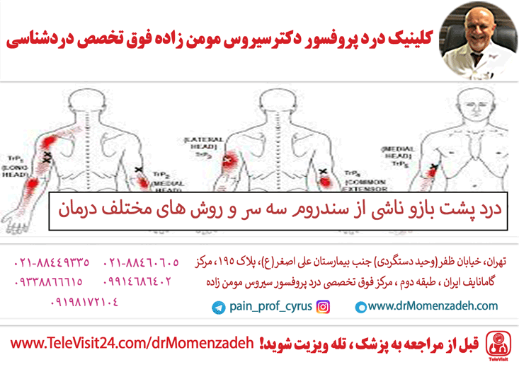 درد پشت بازو ناشی از سندروم سه سر و روش های مختلف درمان