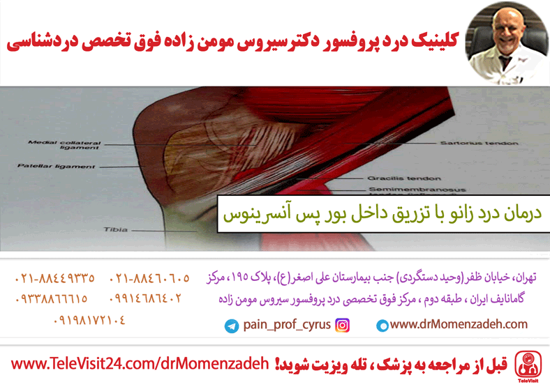 درمان درد زانو با تزریق داخل بور پس آنسرینوس (Pes Anserinus Bursa)