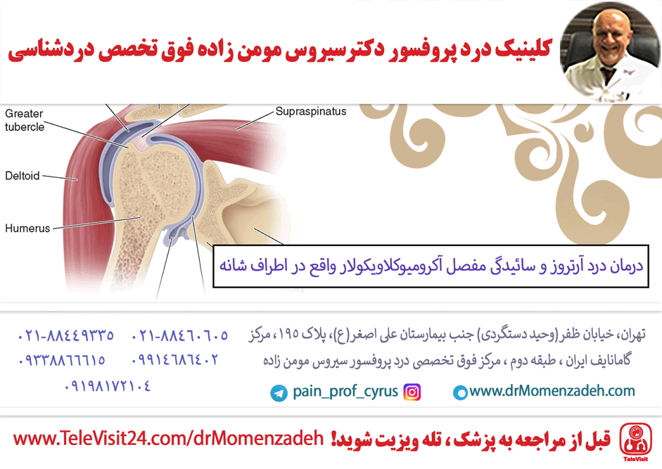 درد آرتروز و سائیدگی مفصل آکرومیوکلاویکولار واقع در اطراف شانه