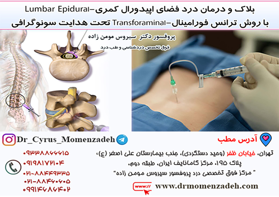 بلاک و درمان درد فضای اپیدورال کمری-Lumbar Epidural با روش ترانس فورامینال Transforaminal تحت هدایت 