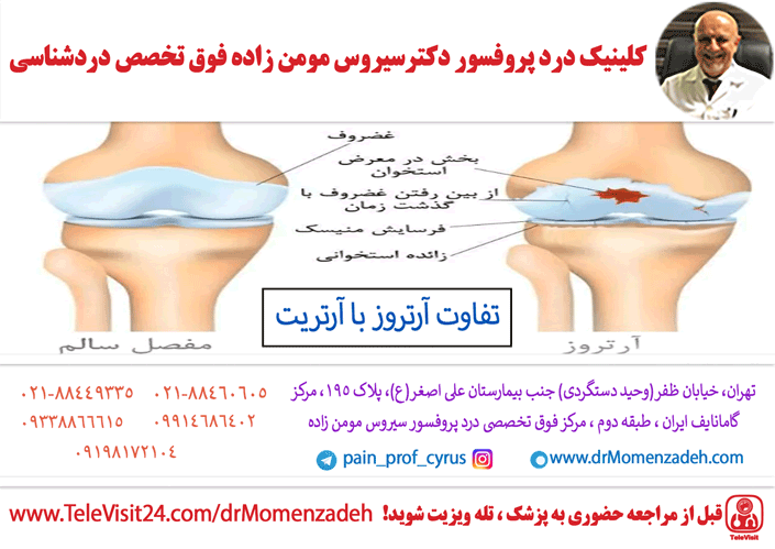 تفاوت آرتروز با آرتریت