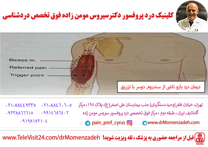 درمان درد بازو ناشی از سندروم دوسر (Biceps) با تزریق